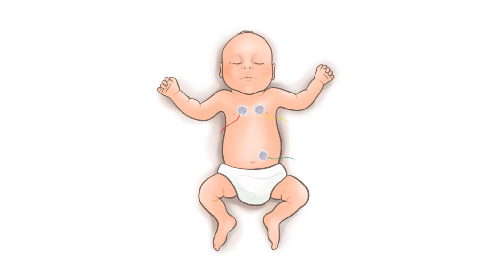 Schematische Darstellung eines Babys mit Elektroden auf dem Abdomen