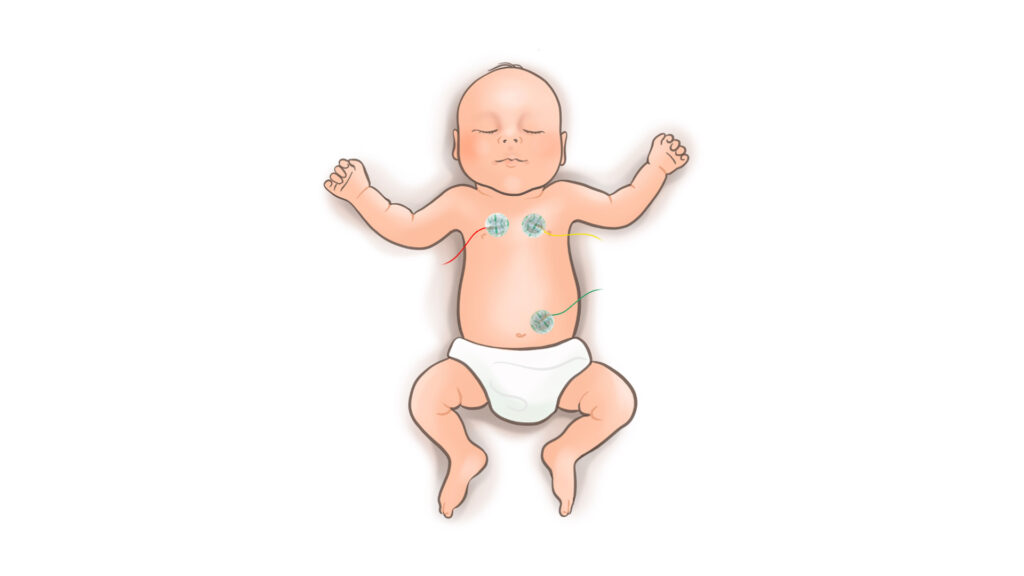 Schematische Darstellung eines Babys mit Elektroden auf dem Abdomen